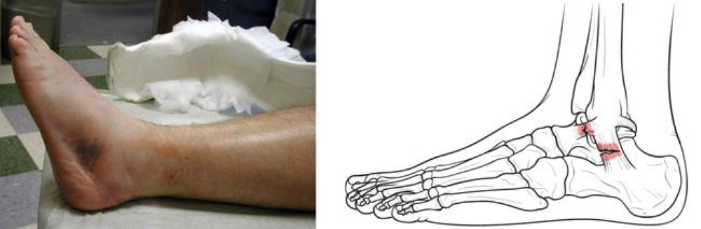 ankle arthroscopy