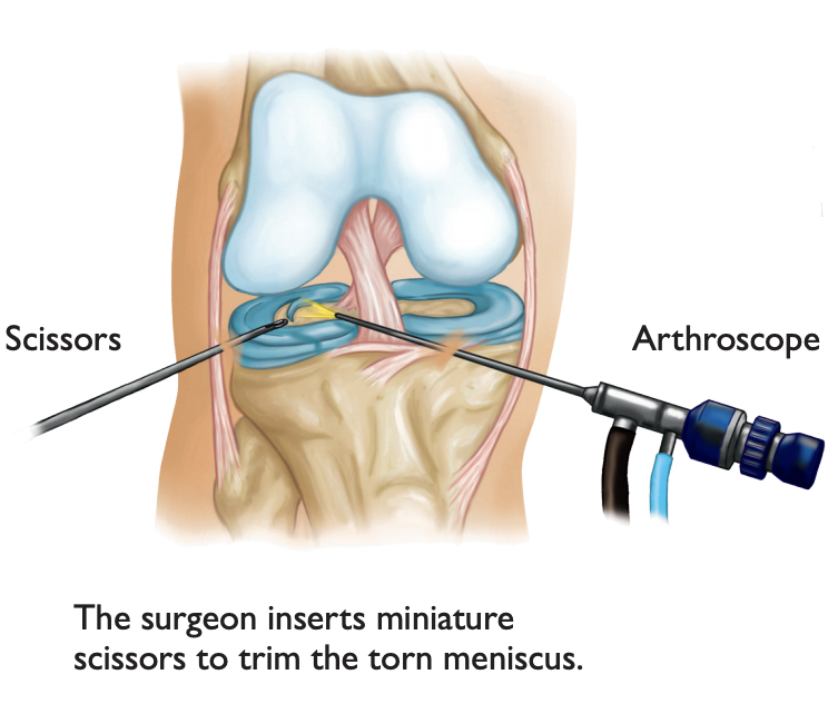 knee arthroscopy and lateral release