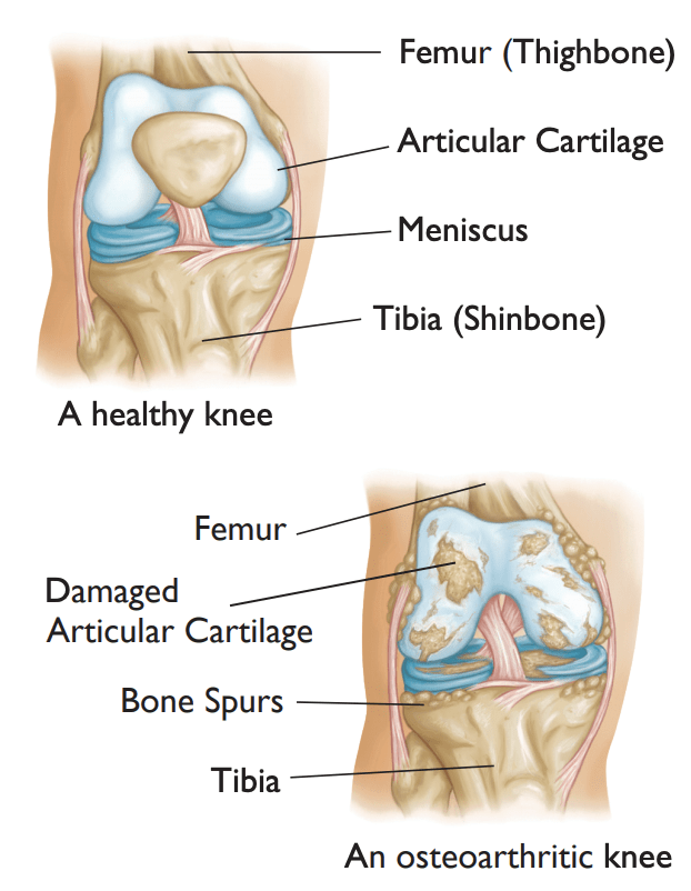 knee arthroscopy recovery
