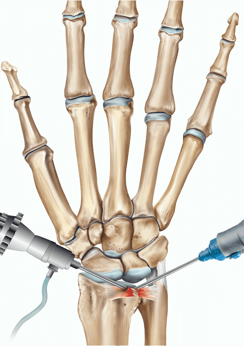wrist arthroscopy aftercare